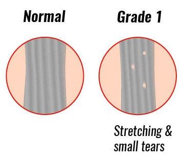 What Is The Best Ligament Knee Brace For Me? Ultimate Guide for ACL ...