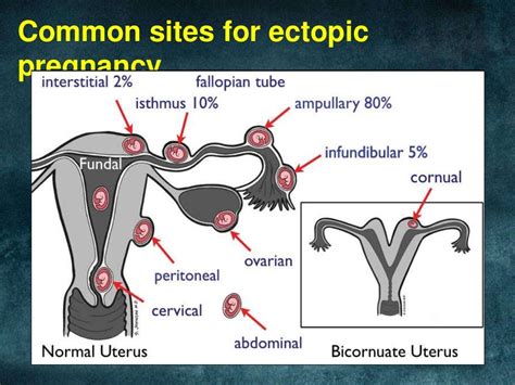 Ectopic pregnancy