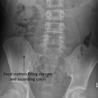 Faecal mass inside terminal ileum mimicking intussusception. | Download Scientific Diagram