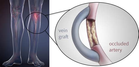 Surgical Bypass – North Texas Vascular Center