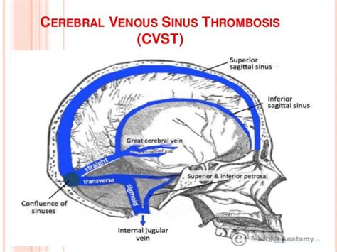 Cerebral Venous Sinus Thrombosis (CVST): Causes, Risks, Complicatio…