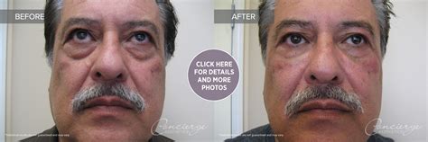 B and A - Juvederm Ultra Under Eyes (64 yo) | Concierge Aesthetics