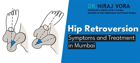 Hip Retroversion Symptoms and Treatment in Mumbai