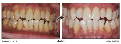 Pinhole® Surgical Technique - Pacific Smiles Dental Implant Center