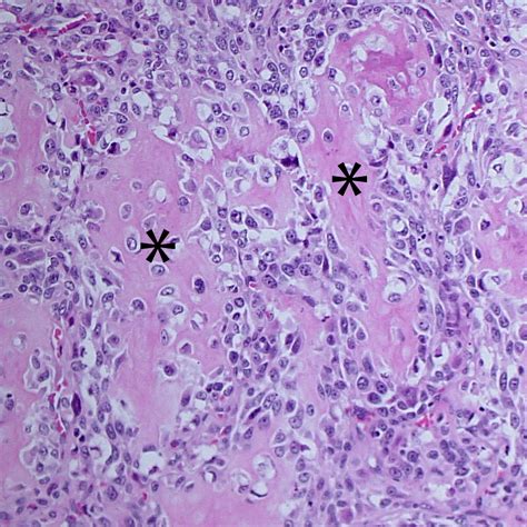 Figure 5. HIstopathologic image of the bone tumor | eClinpath