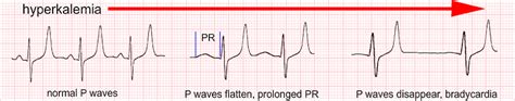 5 ECG Changes of Hyperkalemia you Need to Know – Acadoodle – Medium