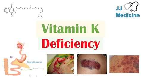 Vitamin K Deficiency | Dietary Sources, Causes, Symptoms, Diagnosis, Treatment - YouTube