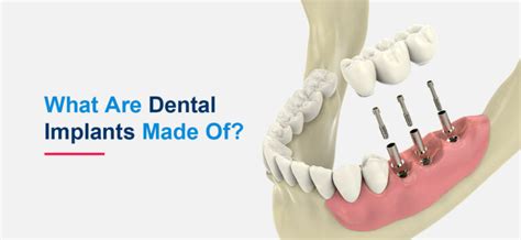 Dental Implants - Hiossen® Implant