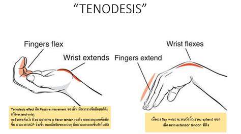 Tenodesis effect... - Clinical Anatomy