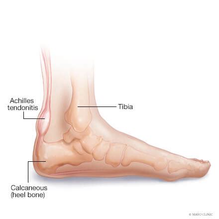 Achilles tendon - Overview - Mayo Clinic Orthopedics & Sports Medicine