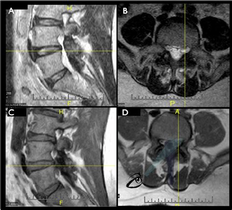 Example of a “ ligamentum flavum cyst ” adjacent to the left L4/L5... | Download Scientific Diagram