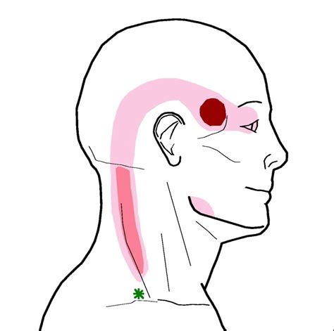 Upper trapezius Trigger Point Referral Pattern Chronic Migraines ...