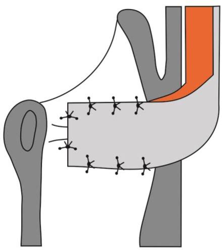 Figure 2 from Reconstruction of the larynx with unipedicled sternohyoid myofascial flap ...