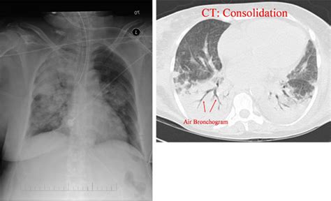 Consolidation – Air Bronchogram – Toronto Notes