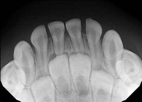 Dental X-Rays: The Whole Tooth – Pediatric Dental Blog