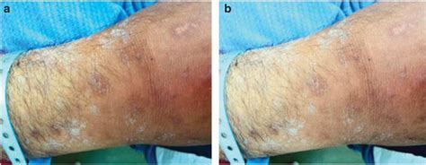 Uremic frost - Kidney International