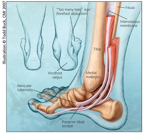 Tips for Avoiding Fallen arches | OrthoFeet