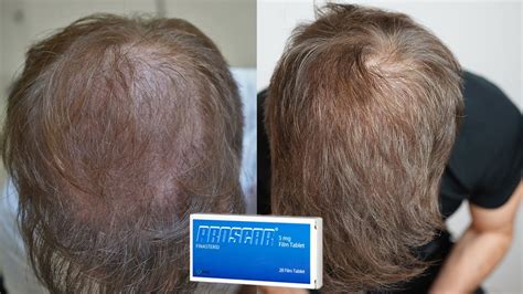 My Finasteride Results After 1 Year | Matt Dominance Finasteride Progress