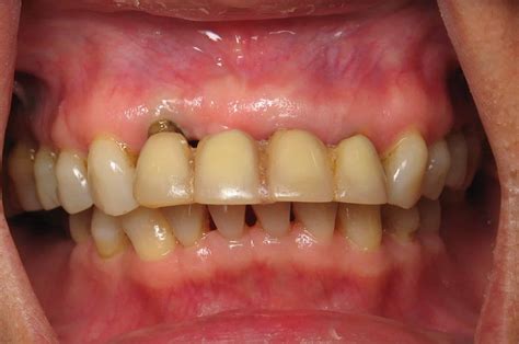 The Ovate Pontic – Ramsey Amin DDS of Burbank Explains This Dental Implant Bridge Detail