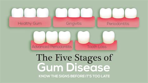 Gum Recession Treatment Cost in India