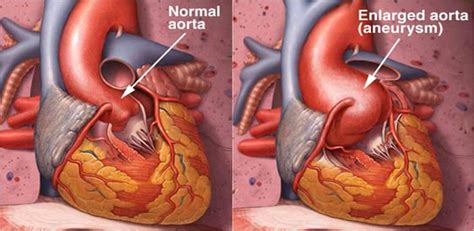 Marfan Syndrome Aortic Dissection