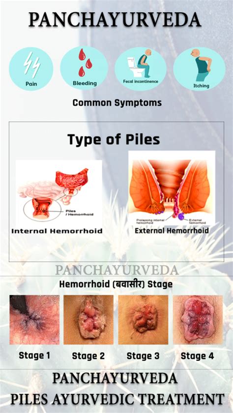 बवासीर का आयुर्वेदिक इलाज -फर्क 3 दिनों में - Panchayurveda