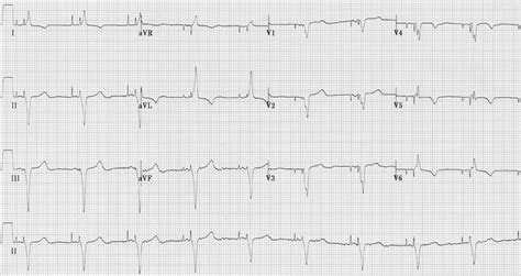 Pacemaker Rhythms – Normal Patterns • LITFL • ECG Library Diagnosis