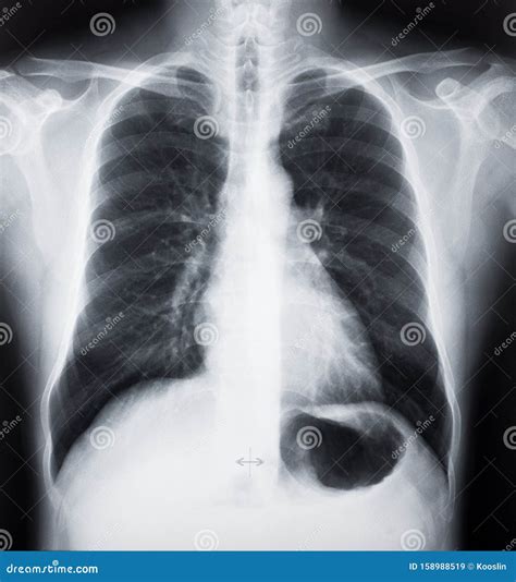 CT Scan Film stock image. Image of breathing, science - 158988519