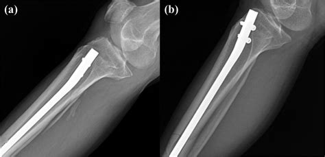 Im Nailing Tibia Procedure - Nail Ftempo