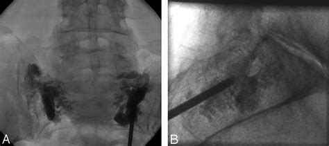 Sacroplasty by CT and Fluoroscopic Guidance: Is the Procedure Right for Your Patient? | American ...