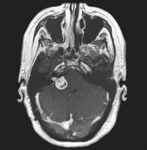 Diagnosis of Facial Nerve Schwannoma by Magnetic Resonance Imaging Enhancement of the Geniculate ...