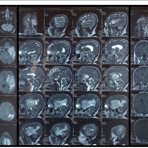 MRI images of the large left sided frontoparietal sphenoidal ridge... | Download Scientific Diagram