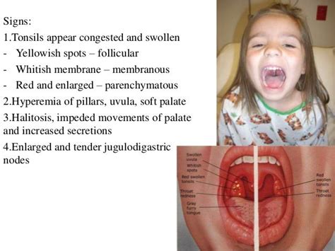 Tonsillitis Vs Normal Tonsils