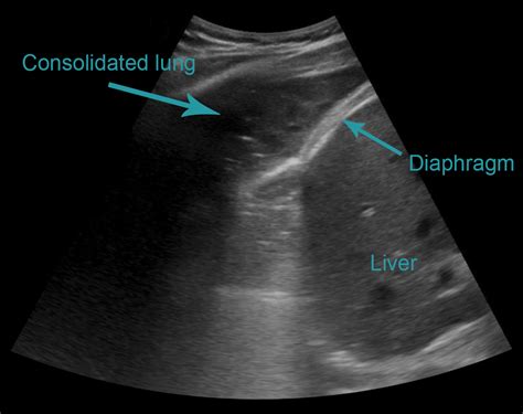 Basic Lung Ultrasound – Animal Ultrasound Association