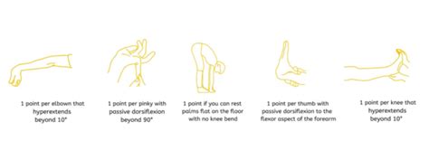 Is the Beighton scale the end-all be-all for an hEDS diagnosis? - The Hypermobile Chiro