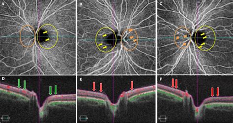 Shows optical coherence tomography angiography (OCTA) images (A-C) of ...