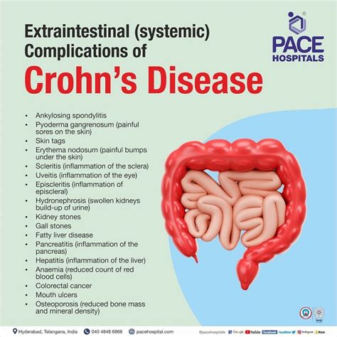 Crohn's Disease - Symptoms, Causes, Complications & Prevention