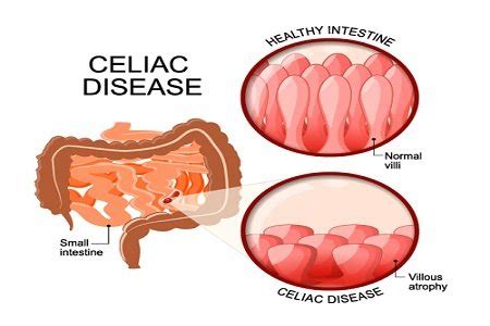 What You Should Know About Celiac Disease