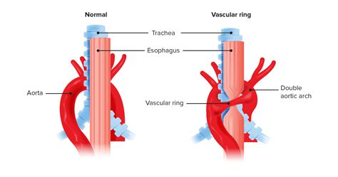 Tracheomalacia Tracheostomy