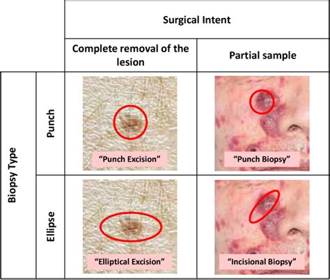 Figure 1 from Skin biopsy in the diagnosis of neoplastic skin disease. | Semantic Scholar