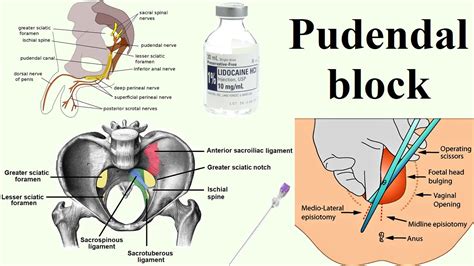 pudendal block - YouTube