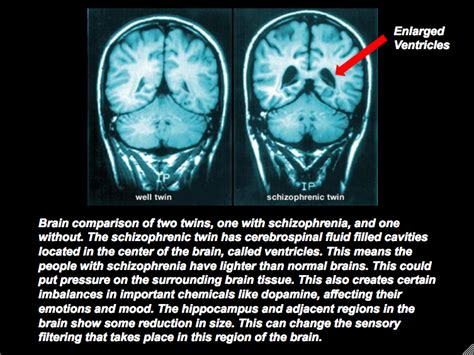 Differences in the Brain Poster - Schizophrenia