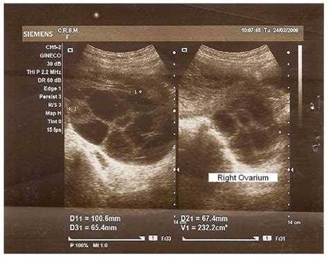 Ultrasound aspect of the right ovary with 232 cc, showing large theca... | Download Scientific ...