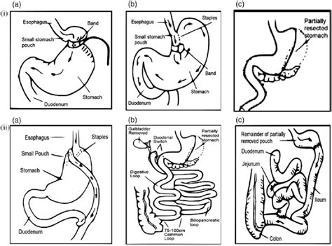 Description of different bariatric procedures and their complications.... | Download Scientific ...