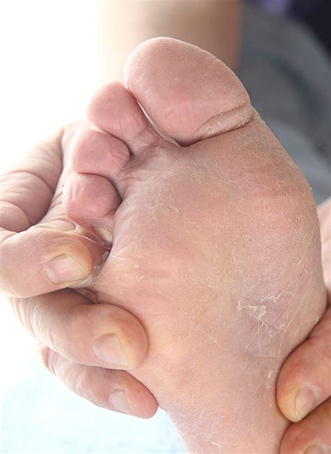 Skin Conditions - Ottawa Foot Clinic