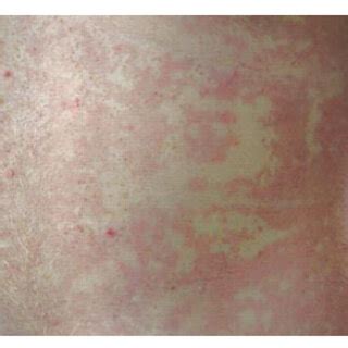 The serpiginous, nonpruritic rash of erythema marginatum, which... | Download Scientific Diagram