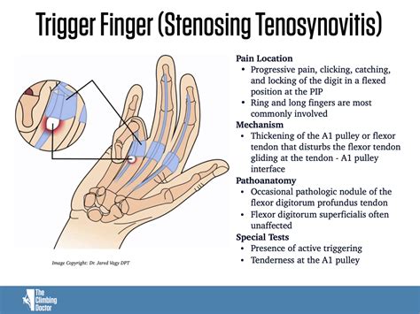 Trigger Finger Definition Etiology Symptoms Diagnosis