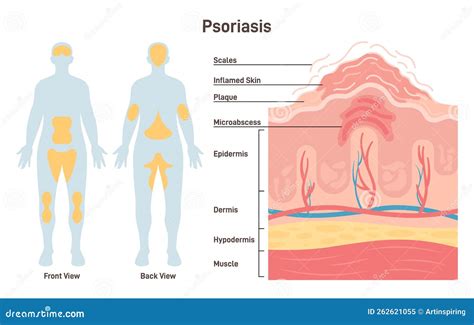 Psoriasis. Autoimmune Disease Characterized by Areas of Inflamed Skin Stock Vector ...