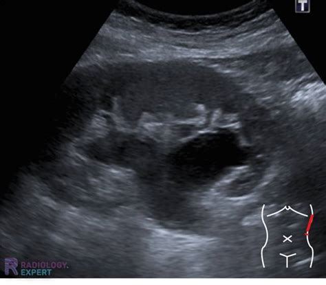 Abdominal ultrasound