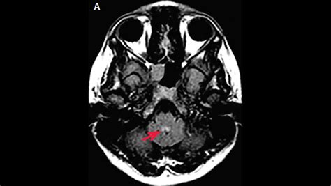 Spinal Cord Lesions - The Neurology Hub